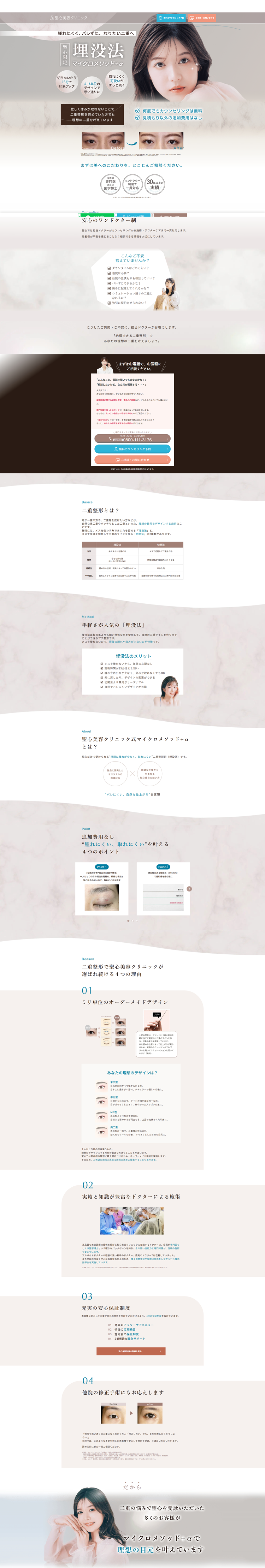 二重整形（埋没法）：マイクロメソッド＋α